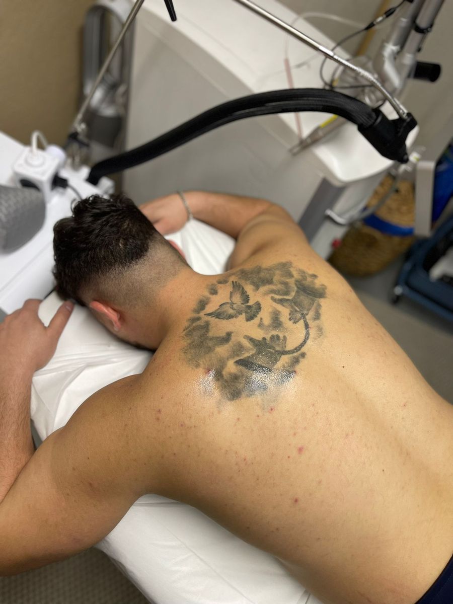 Tattooentfernung mit dem Nd:YAG-Laser im Studio