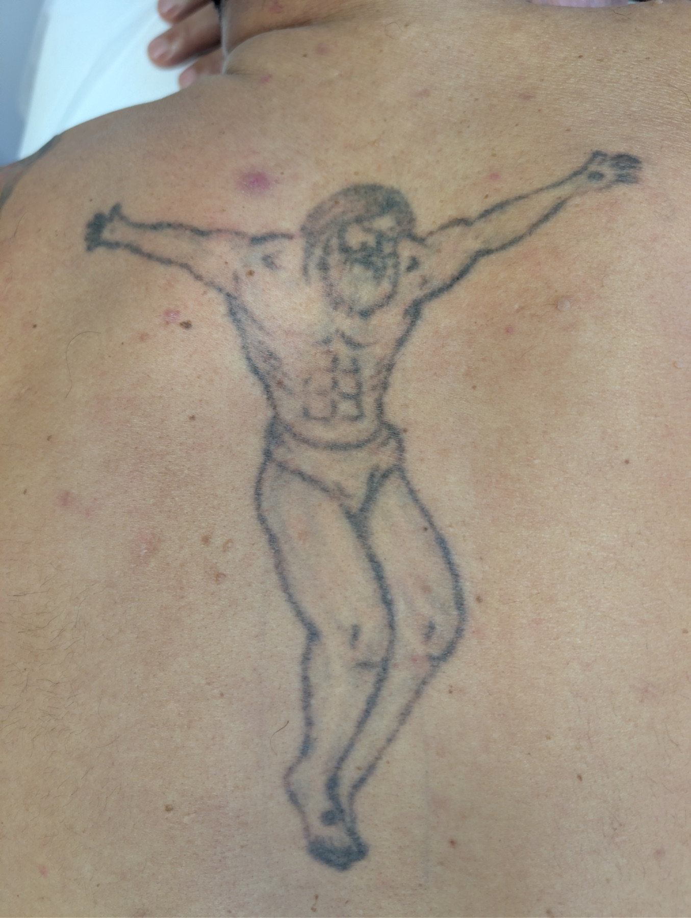 Tattoo mit erster sichtbarer Aufhellung