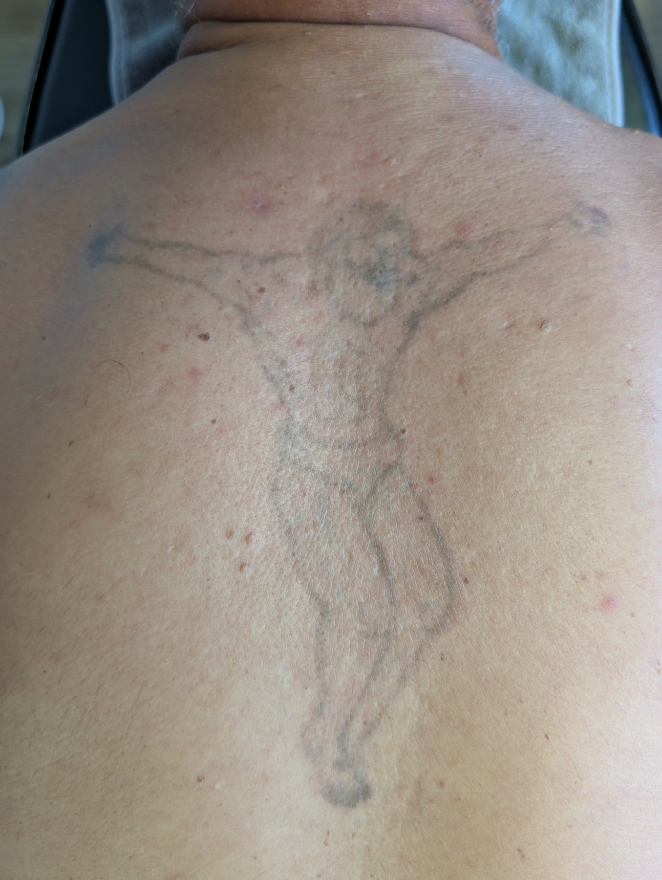 Tattoo im aktuellen aufgehellten Zustand