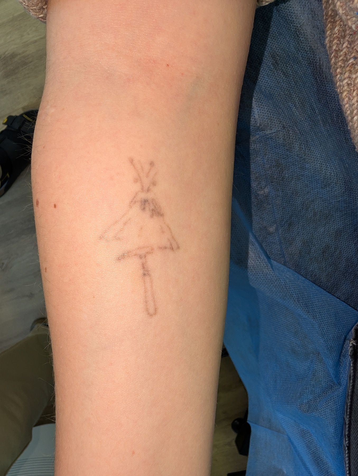 Tattoo im weiteren Behandlungsverlauf