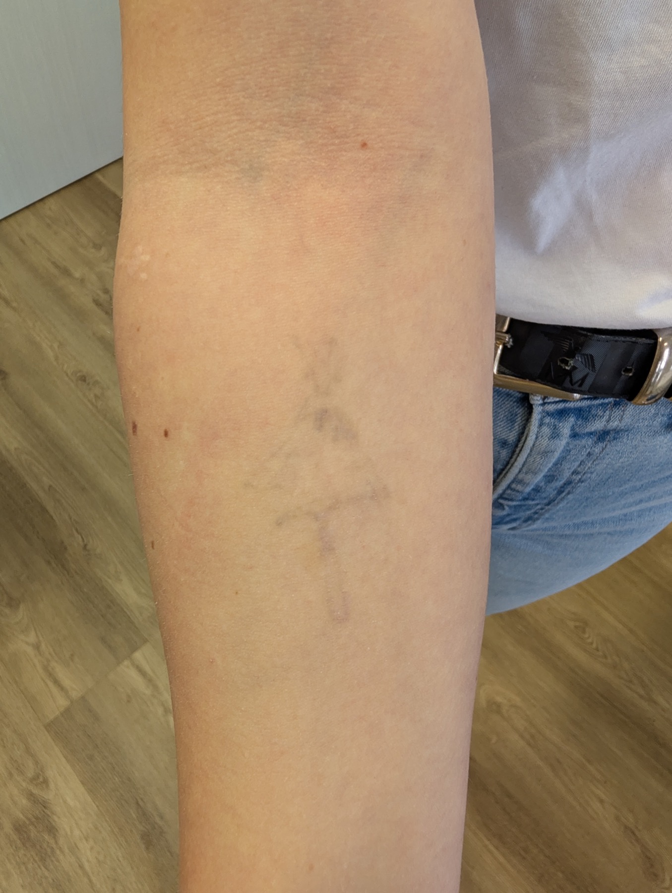 Tattoo nach sichtbarer Aufhellung